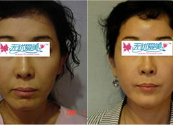 面部松弛照片,面部松弛困扰？揭秘改善松弛肌肤的秘诀